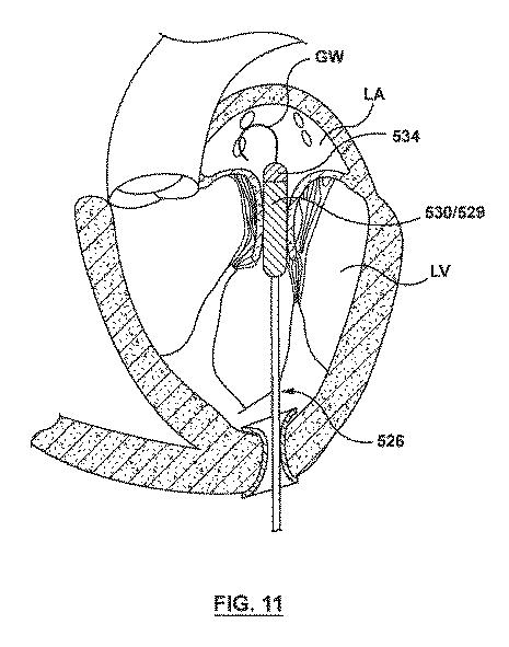 2020501633-原位置で腱索を管理するための一体型変位構成要素を有する弁送達システム、及びその使用方法 図000014