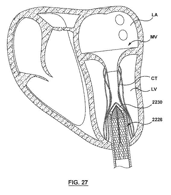 2020501633-原位置で腱索を管理するための一体型変位構成要素を有する弁送達システム、及びその使用方法 図000030