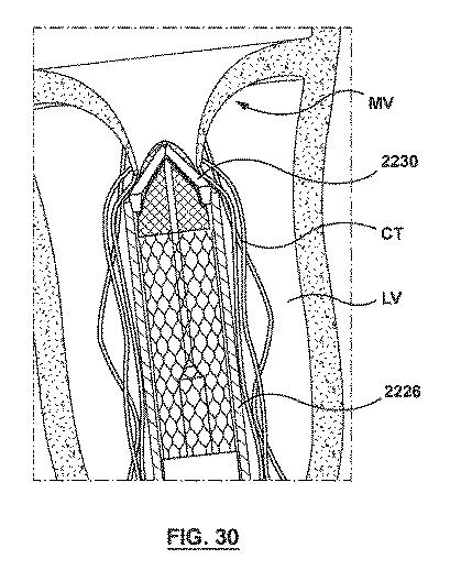 2020501633-原位置で腱索を管理するための一体型変位構成要素を有する弁送達システム、及びその使用方法 図000033