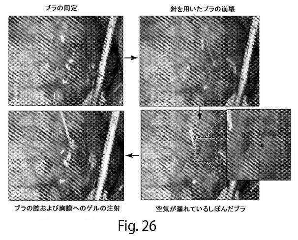 2017513928-肺大気胞を治療するための自発組織化ペプチド 図000036