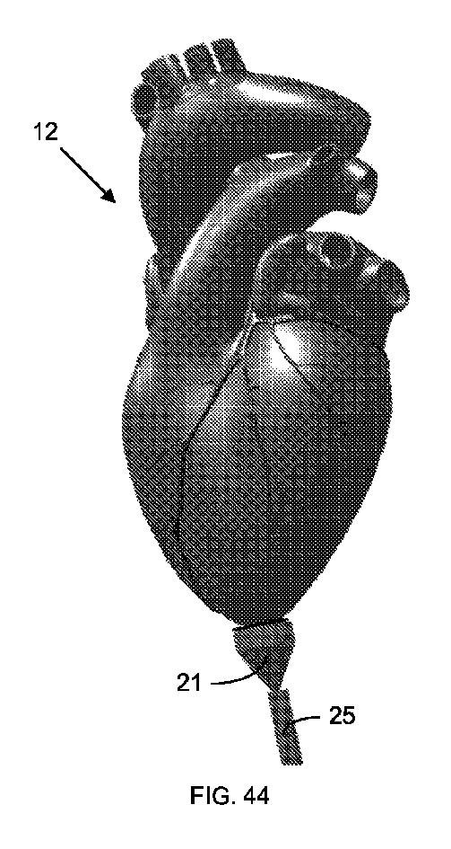 2017516536-光を伝達して反射させるためのカテーテル装置 図000046